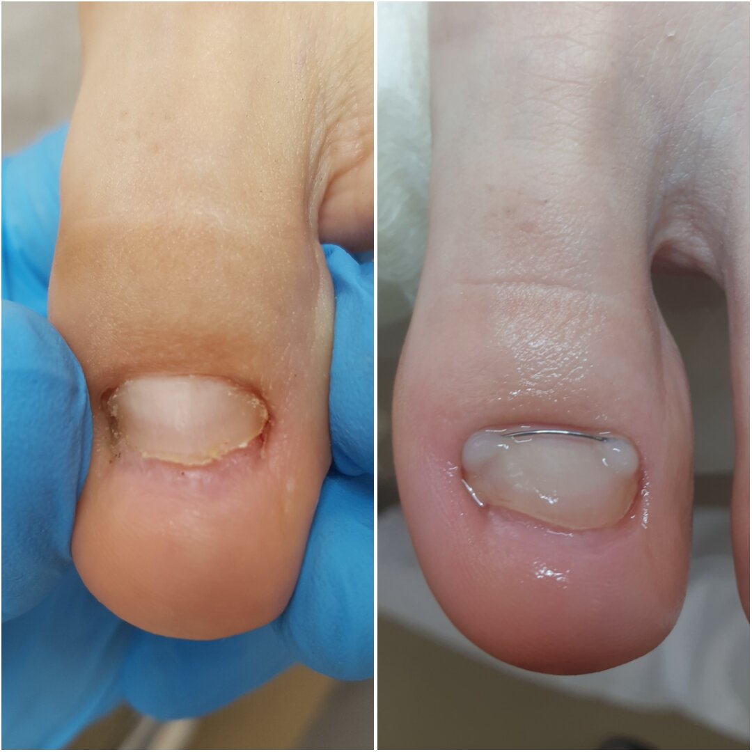 Лечение вросшего ногтя B/S пластинами и скобами