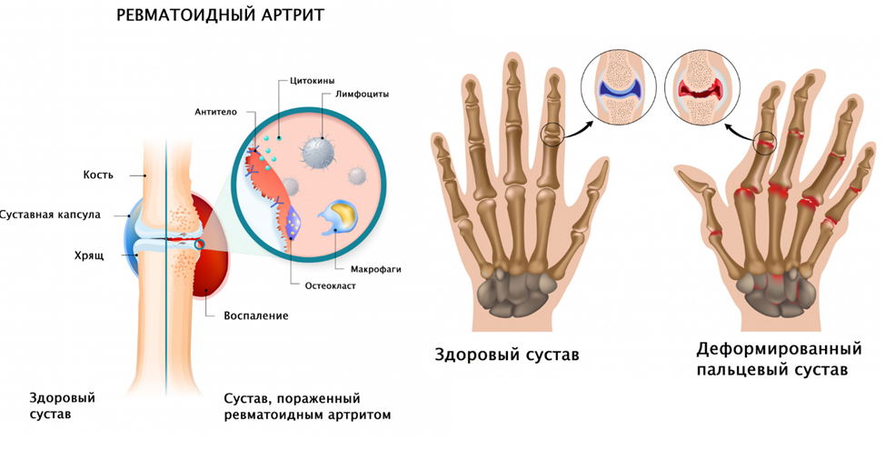 Ревматоидный артрит ног: лечение и симптомы - статьи от компании Еламед