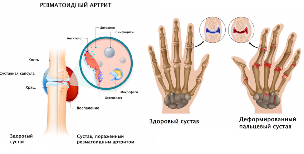 Ревматоидный артрит что это