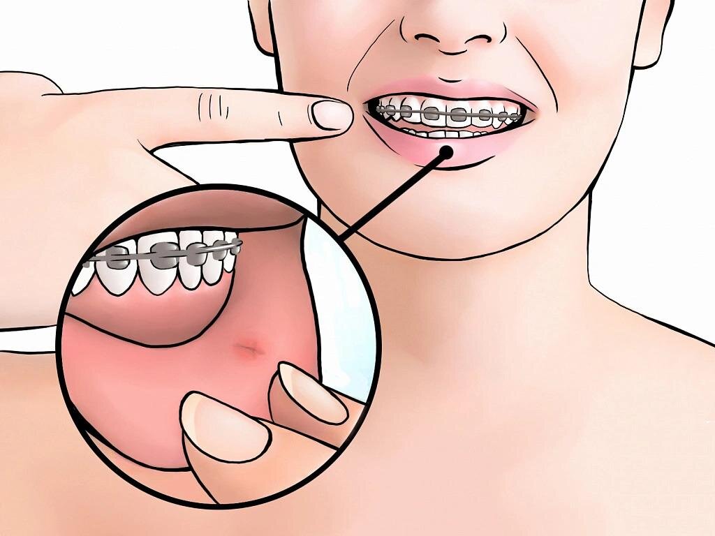 Чтобы облегчить коррекцию прикуса, соблюдайте рекомендации по питанию и уходу за ротовой полостью и брекетами 