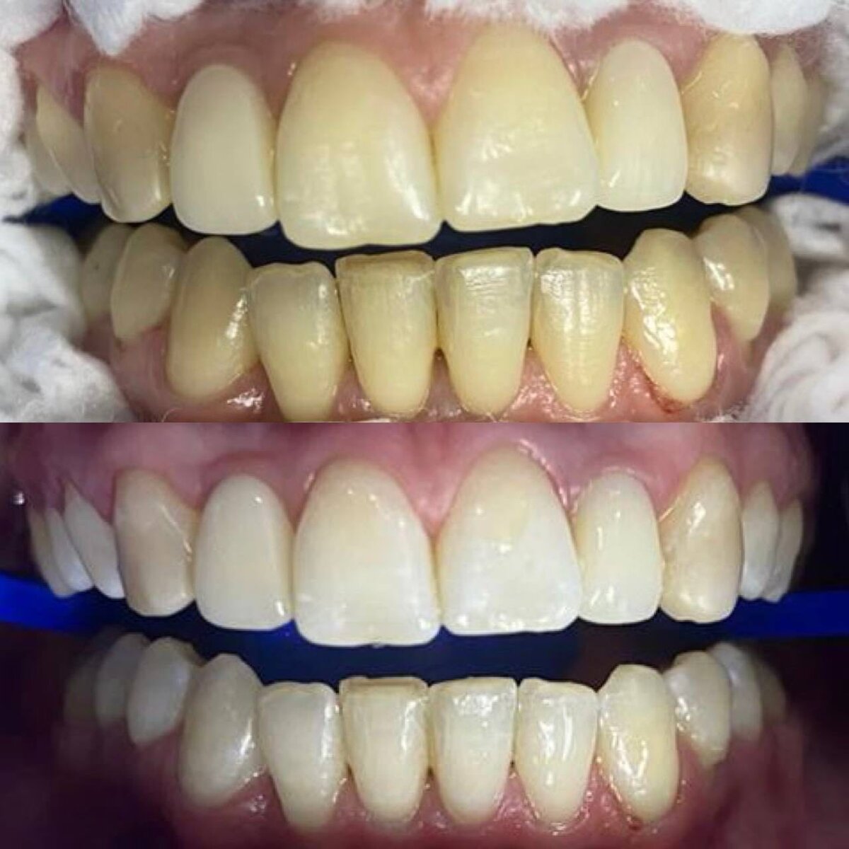 Пример профессионального отбеливания зубов у нас в клинике 