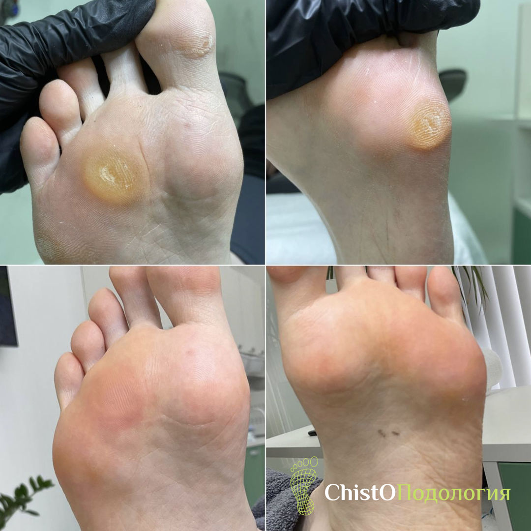 Кератоз: до и после