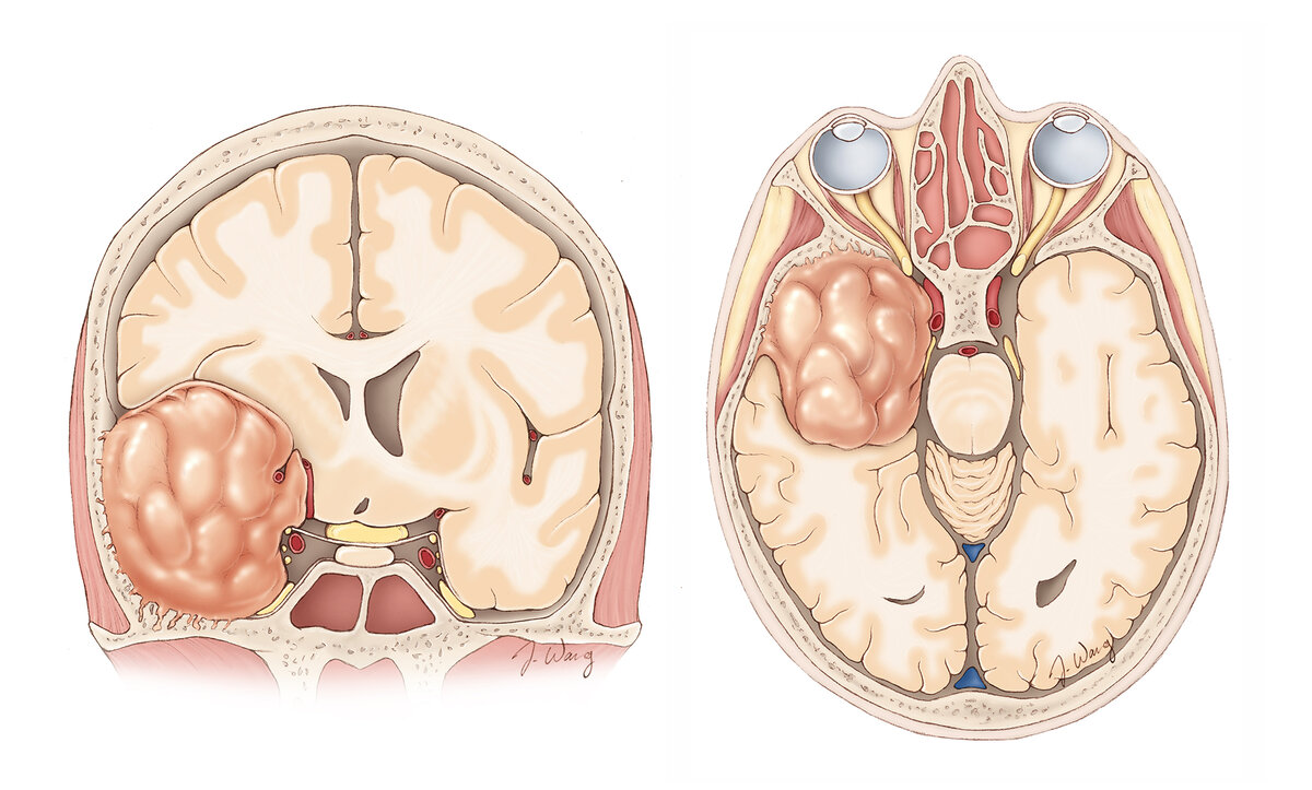 МЕНИНГИОМА - виды опухоли головного мозга - симптомы, диагностика и лечение  | Mednavigator.ru | Дзен