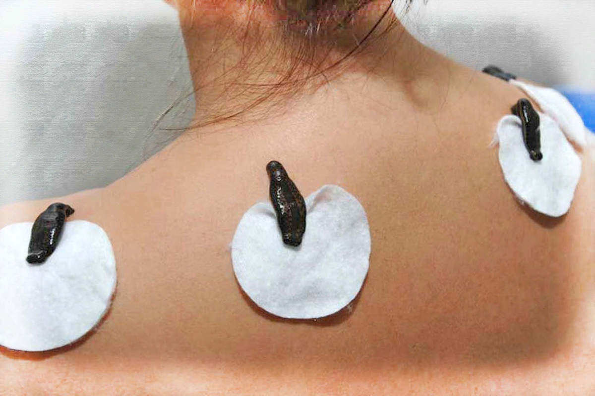 Опыт Дуремар с процедурой омоложения пиявками