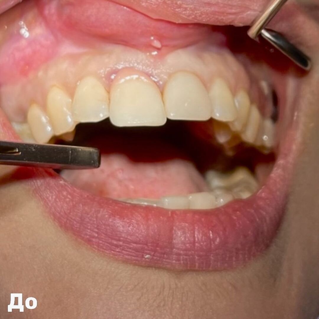 Подвижность зуба: коронка установлена 8 лет назад, десна в это месте поднялась и ортопед изготовил коронку с искусственной  десной