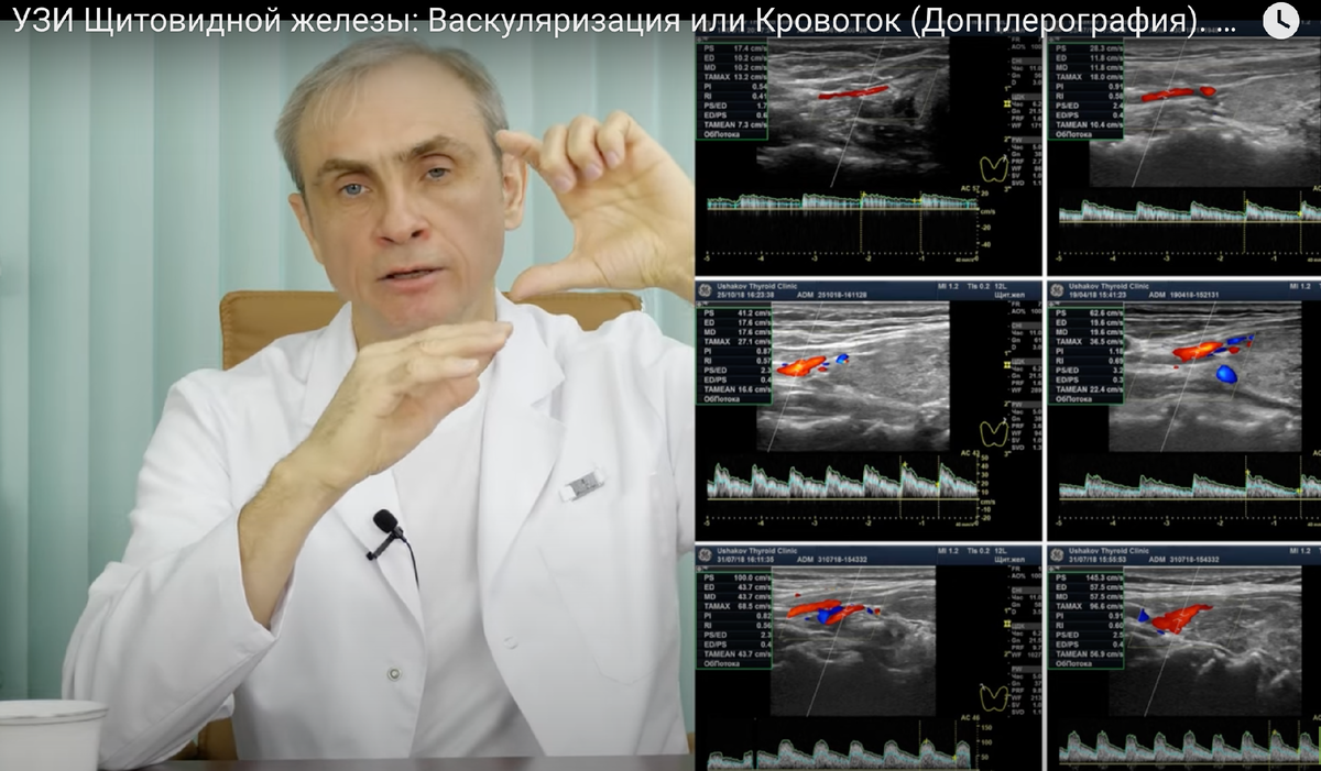 Доктор Ушаков (кадр из фильма о кровотоке щитовидной железы / васкуляризации)