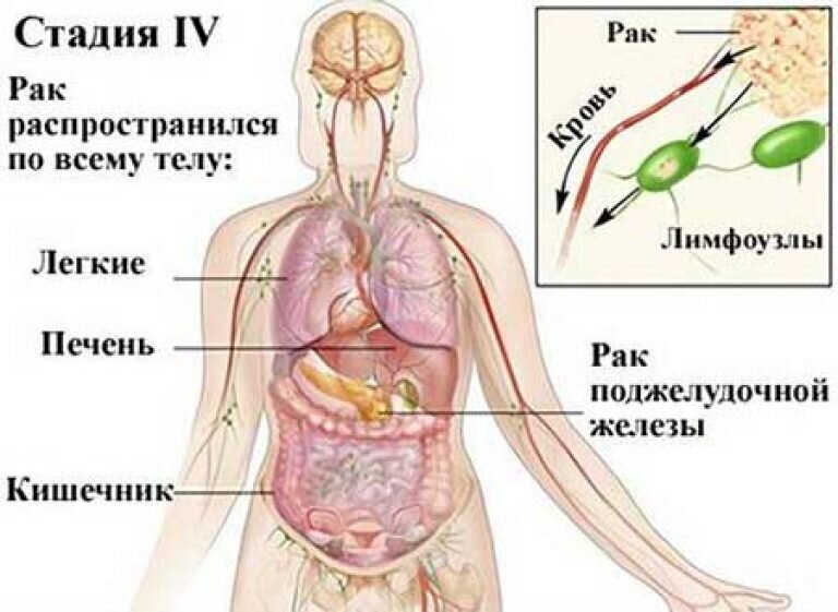 Прогноз 4 стадии рака. Метастазы 4 степени поджелудочной железы. Опухоли поджелудочной железы 4 стадии.