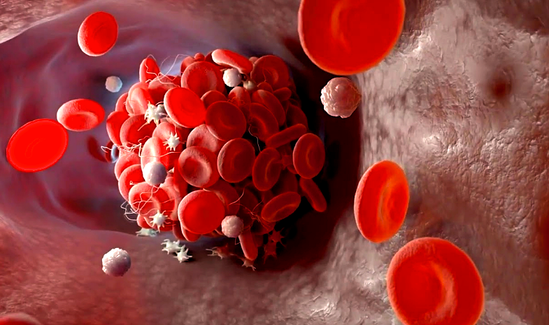 Эти 3 "Молчаливых" симптома могут появляться, когда образуются тромбы ...