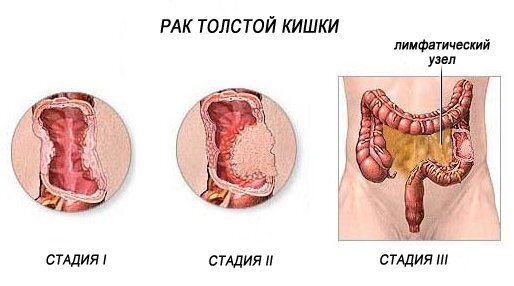 Спастический колит кишечника: симптомы проявления, диагностика и лечение