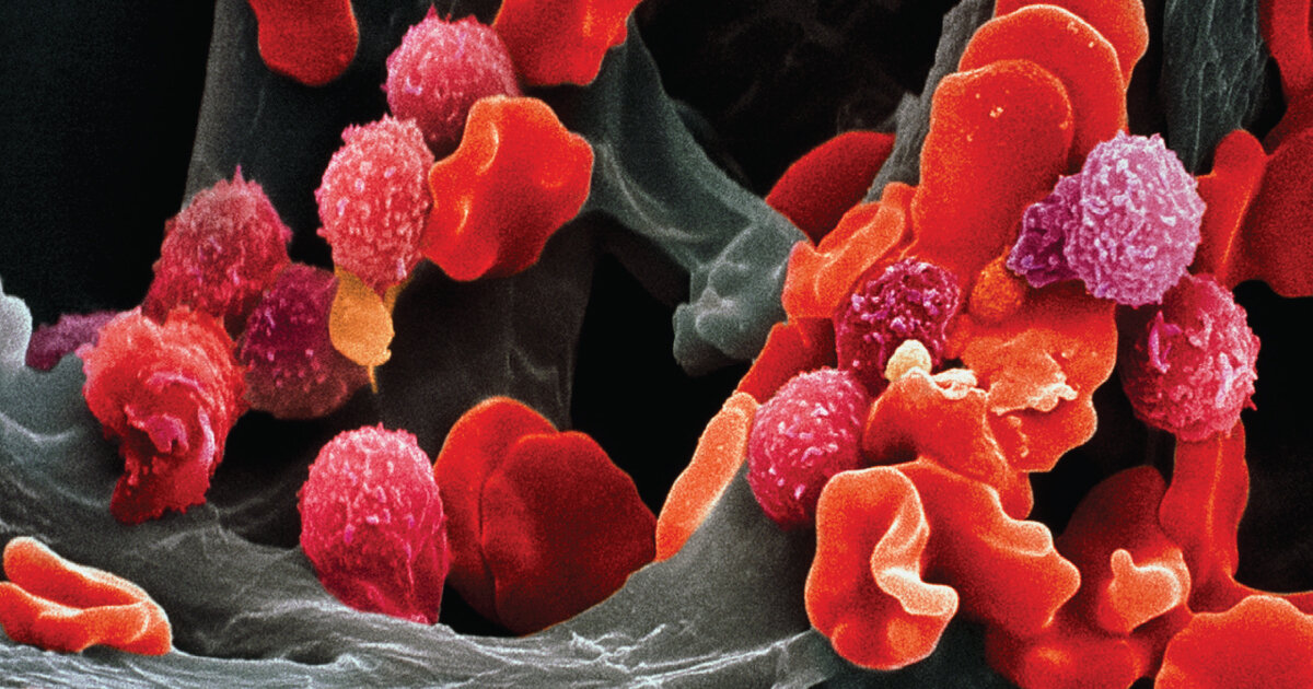 Лейкоз под микроскопом. Кровь под микроскопом. Микрофото клеток крови. Раковые клетки микрофотографии. Онкозаболевания крови