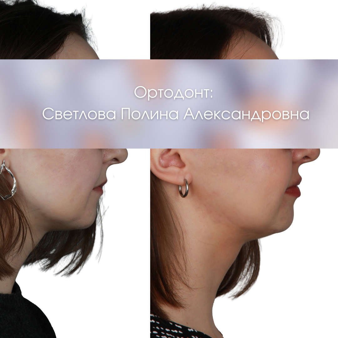 Ортодонтическое лечение на брекет-системе без ортогнатической хирургии