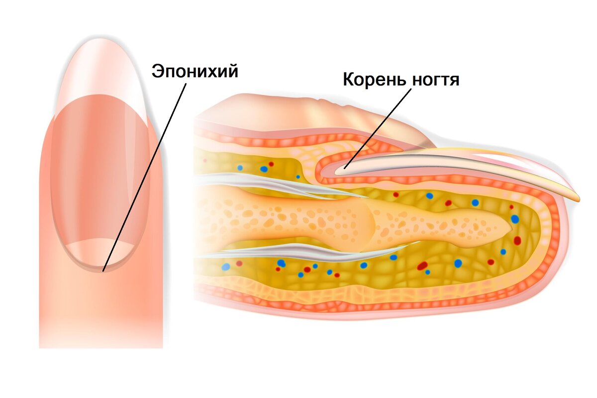 Панариций ногтевой пластинки