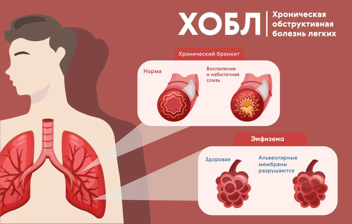 5 заболеваний легких