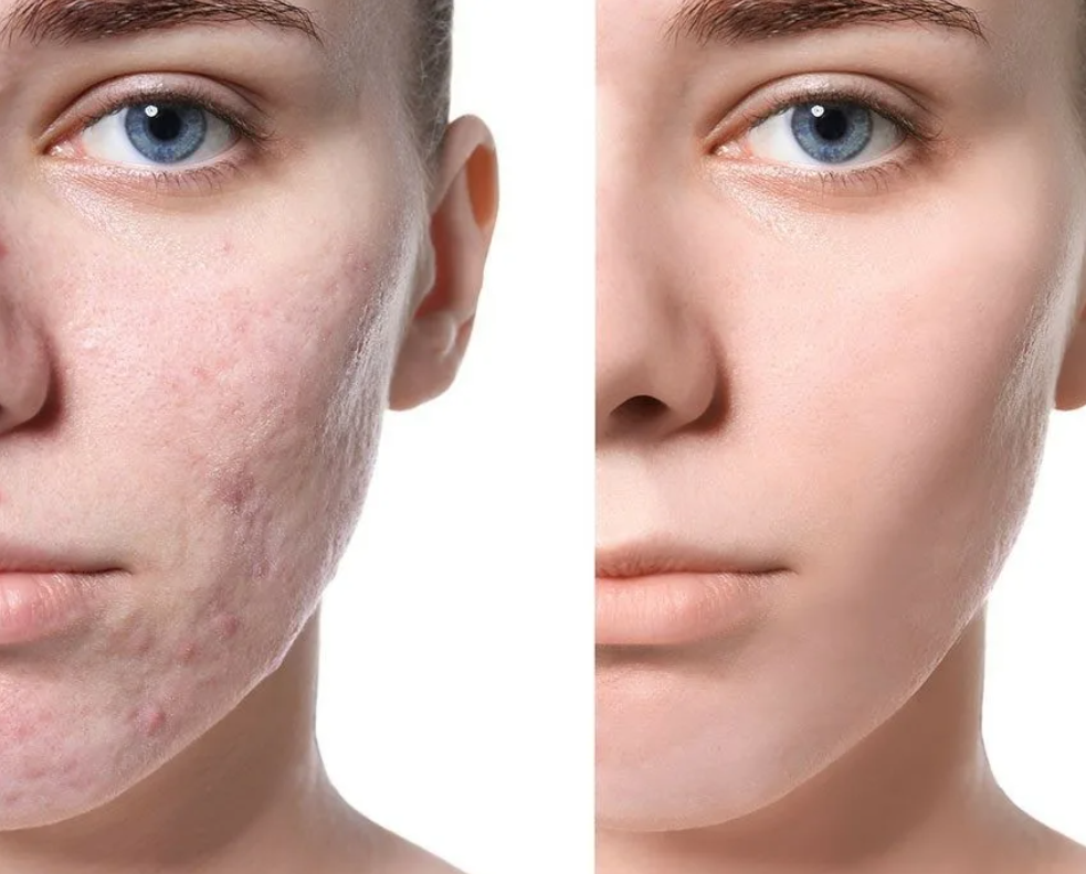 Акне постакне холодная плазма. Фототерапия лазером акне. Электрокоагуляция анестезия. Лазерная терапия в дерматологии. Лазерное удаление акне.