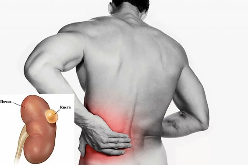 -Доктор у меня болит почка, там киста. Назначьте мне что-нибудь!
-А Вы уверены, что спина болит из-за кисты почки?
-Какая спина?! Это почка, я чувствую!...