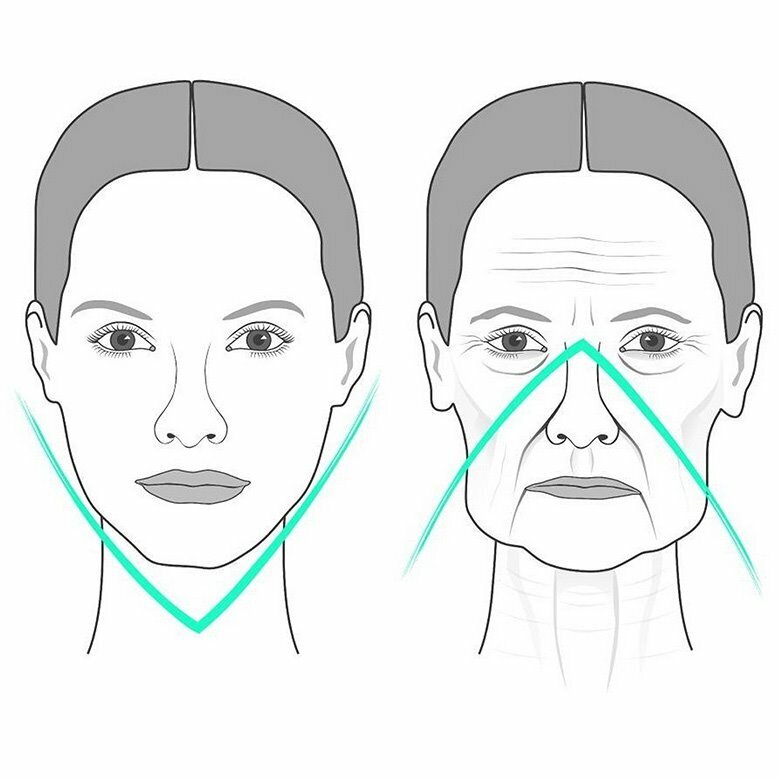 Гравитационный птоз лица. Нечеткий овал лица. Треугольник молодости лица. Схема лица.
