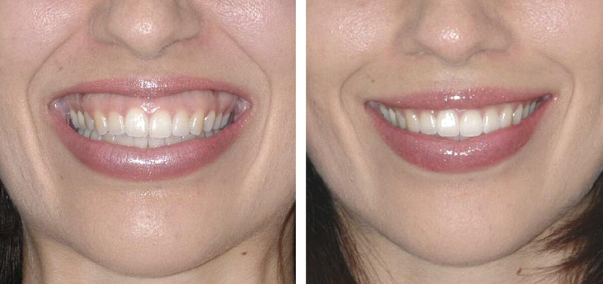 Зубы видны. Десневая улыбка Gummy smile. Коррекция десневой улыбки ботулотоксином. Ботулинотерапия десневая улыбка. Гингивопластика десневая улыбка.