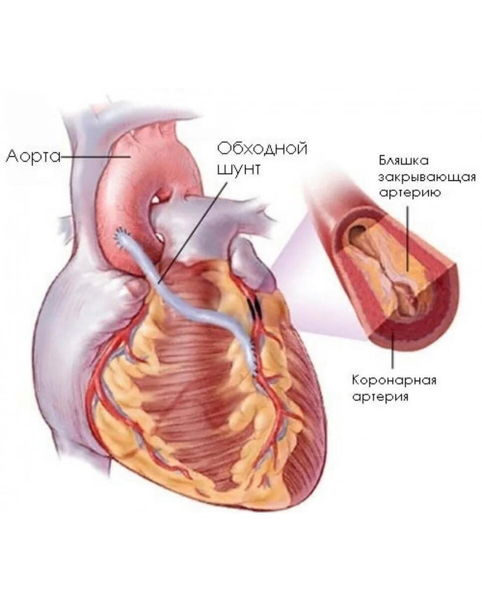 Стентирование и шунтирование сердца - что за операции и как жить после? |  Григорий Нефедов | Дзен