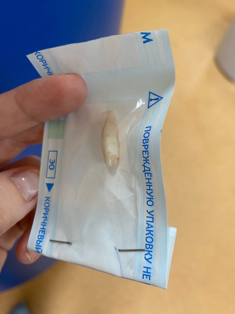 Сверхкомплектный постоянный зуб