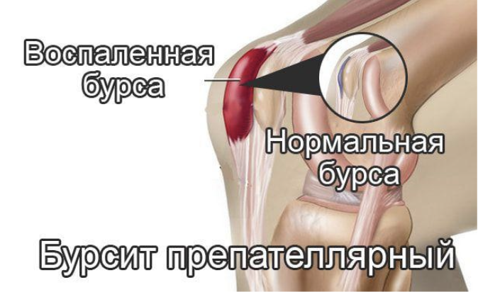 Воспаление сумки сустава