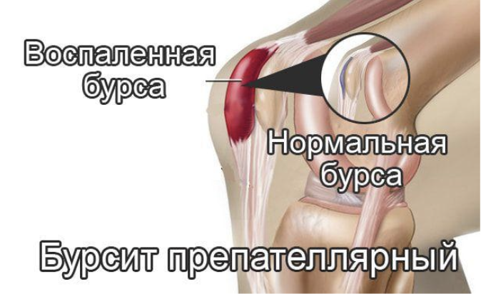 Бурсит коленного сустава народные лечение. Препателлярный бурсит. Инфрапателлярный бурсит. Супрапателлярный бурсит коленного сустава что такое. Инфрапателлярная сумка бурсит.