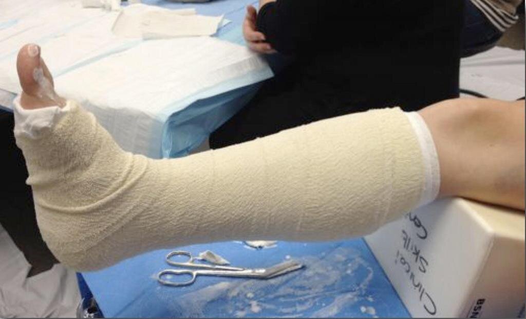 Симптомы перелома! Сколько заживает перелом! 