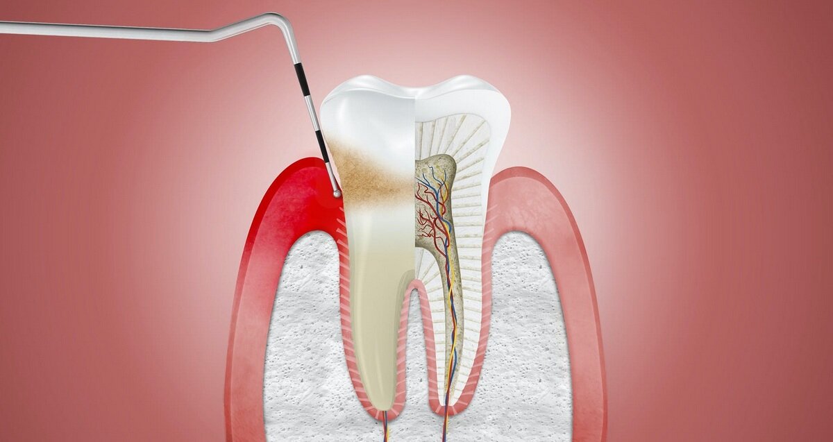 Пародонтальный абсцесс и его лечение - САИДА - клиника стоматологии