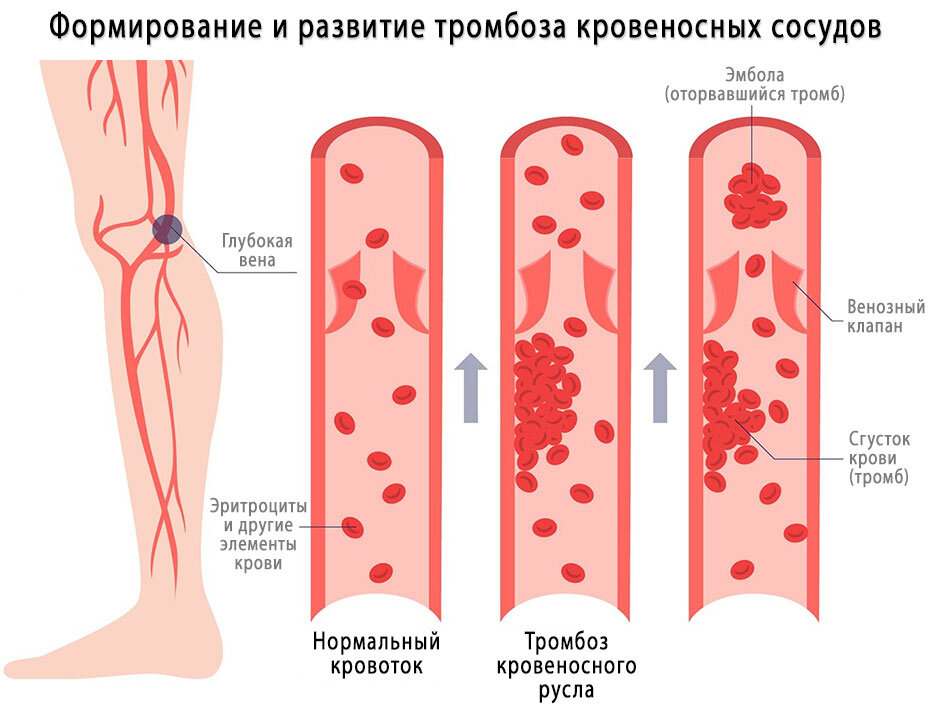 Чем опасны препараты от тромбов? | Анна Кореневич | Врач-кардиолог .