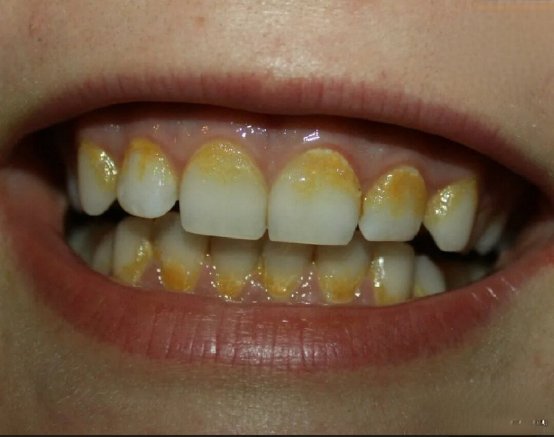 Зуб начал желтеть. Улвбеп с желтыми зубами. Штриховая стадия флюороза. Зуб начал желтеть. Зуб начал желтеть.