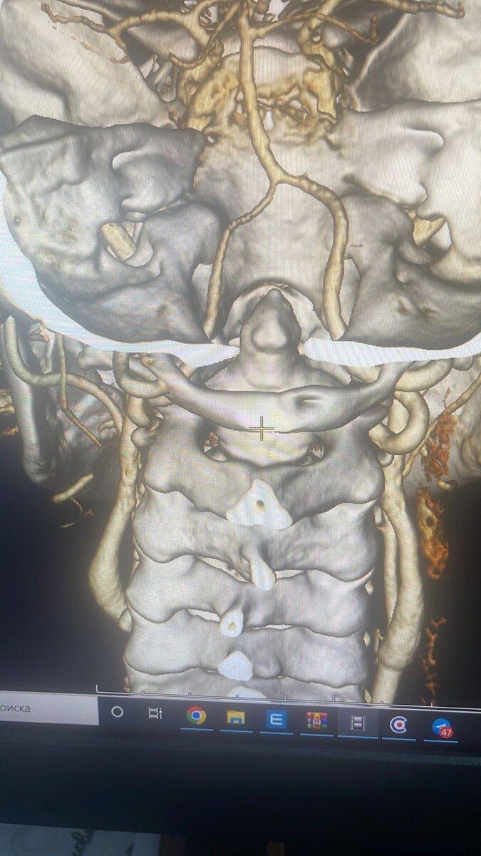 Полная двусторонняя врожденная Аномалия Киммерле с компрессией позвоночных артерий