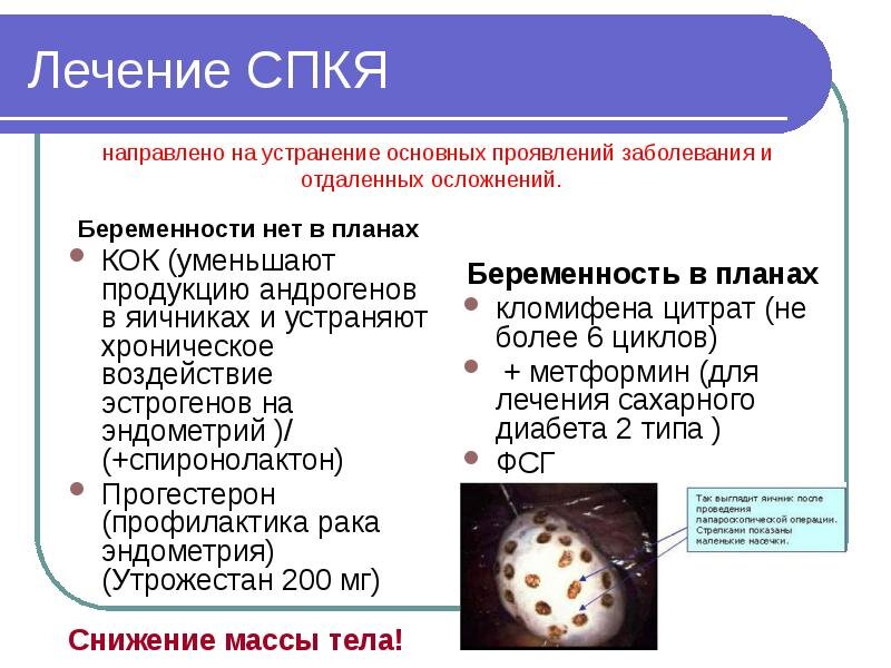 Синдром поликистозных яичников что это такое