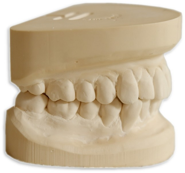 Диагностические гипсовые модели челюстей. Гипсовые модели в стоматологии. Диагностические модели челюстей. Гипсовые модели челюстей. Диагностические модели челюстей.