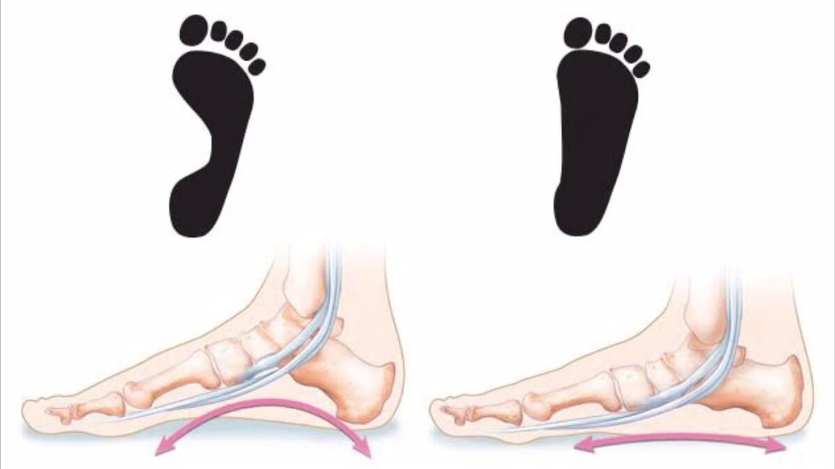 Как выглядят стопы ног. Сводчатая стопа и плоскостопие. Скелет стопы плоскостопие. Стопа с 1 степенью плоскостопия. Поперечное плоскостопие 2 степени.