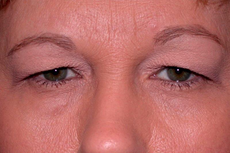 Нависшее веко: как избежать блефаропластики и открыть взгляд естественным способом