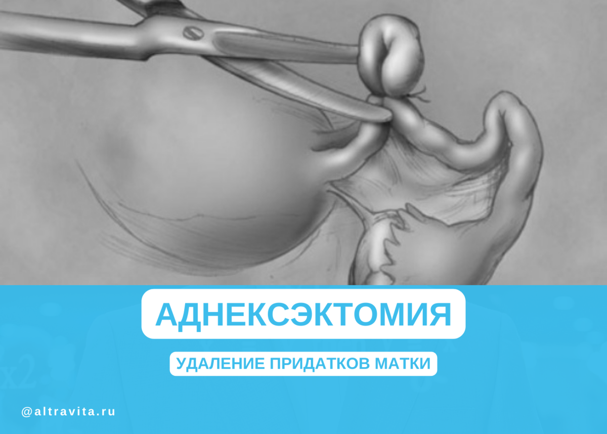 Удаление придатков матки