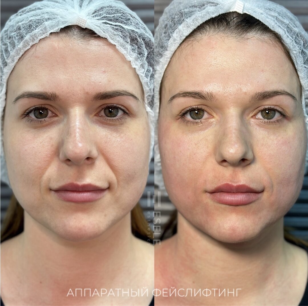 Аппаратный фейслифтинг без инъекций и операций подтягивает овал лица и улучшает контуры. Фото © Центра эстетики и косметологии ESELE 