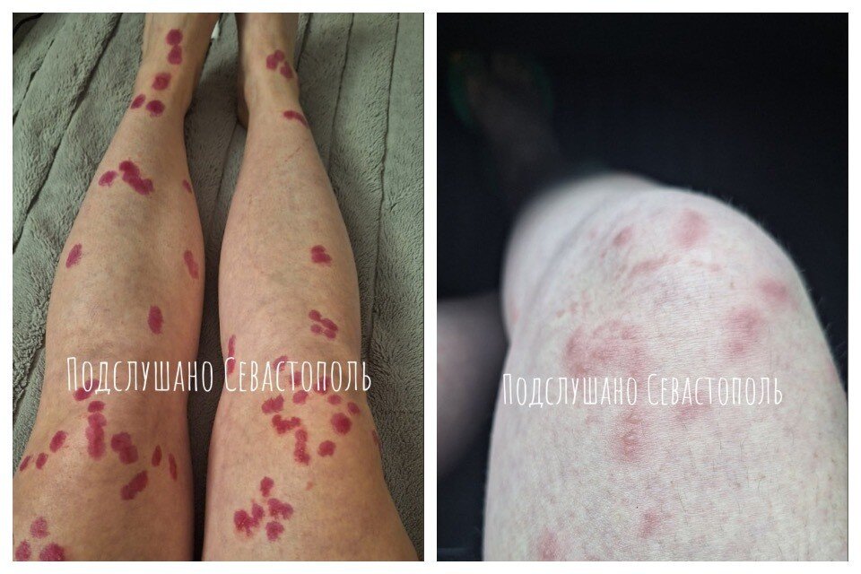    Ожоги проявились спустя несколько часов. Фото: Подслушано Севастополь