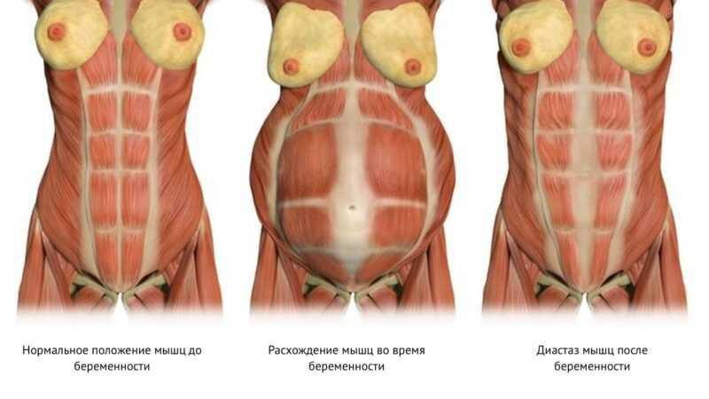 Триггерные точки прямой мышцы живота