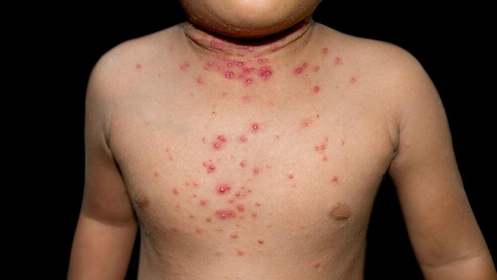 Наконец появилось лекарство от моллюска - вирусной кожной болезни у ...