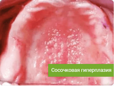 Устранить натертости десны от съемного протеза – методы, сроки, чем снять боль