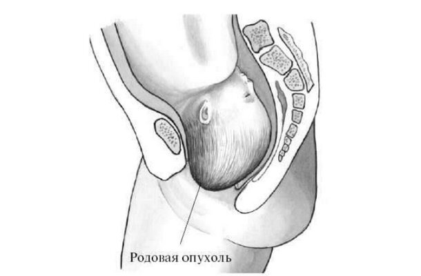 Картинки родовая опухоль