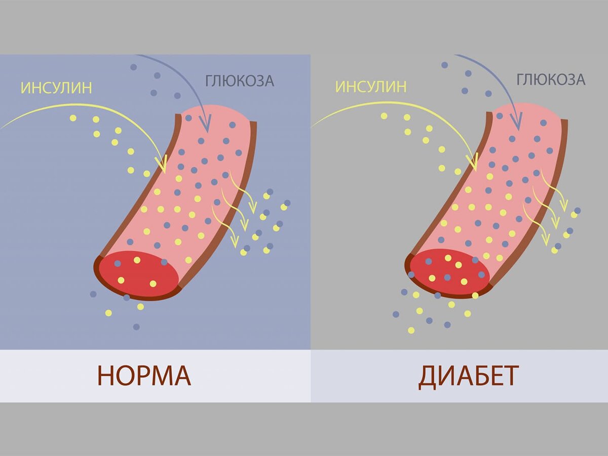 Лечение сахарного диабета