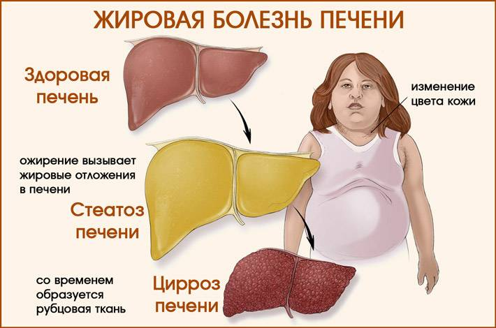 Как выглядит увеличенная печень снаружи фото Чем опасна "жирная печень" и всегда ли она бывает только у пьющих людей? Отвечае