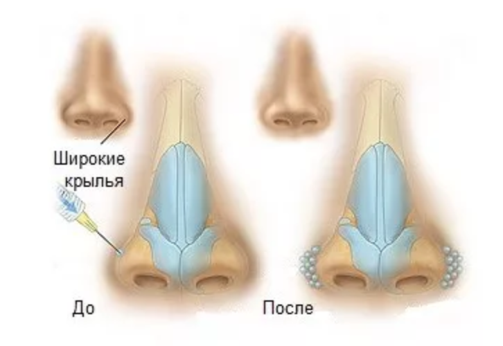 Ринопластика крыльев носа. Уменьшениемкрыльеа носа.