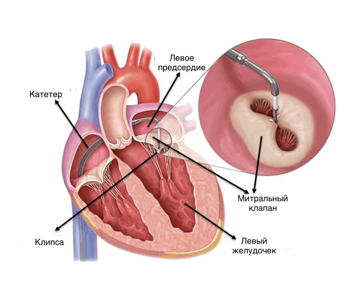 Порок сердечных клапанов и сердечная недостаточность