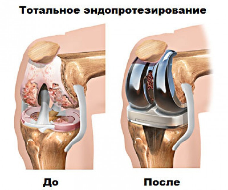 Форум операции по замене суставов. Эндопротез коленного сустава Stryker. Stryker протез коленного сустава. Тотальное эндопротезирование коленного сустава. Эндопротез коленного сустава операция.