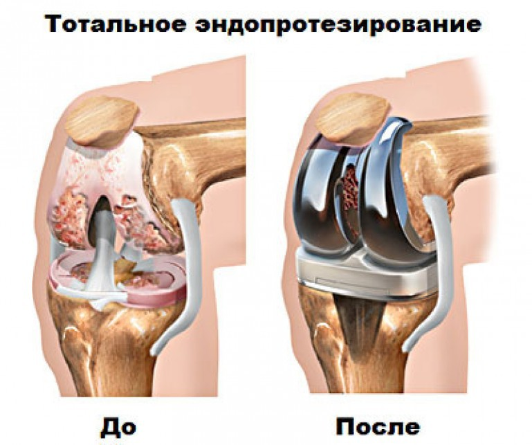 Колена отзывы. Тотальное эндопротезирование коленного сустава. Тотальный эндопротез коленного сустава. Эндопротезирование коленного сустава операция. Протез Stryker коленного сустава.