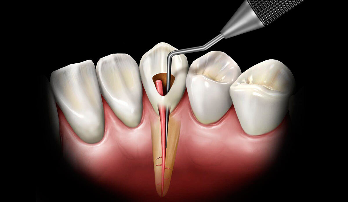 Лечение каналов зуба | Стоматология Екатеринбург | Дзен
