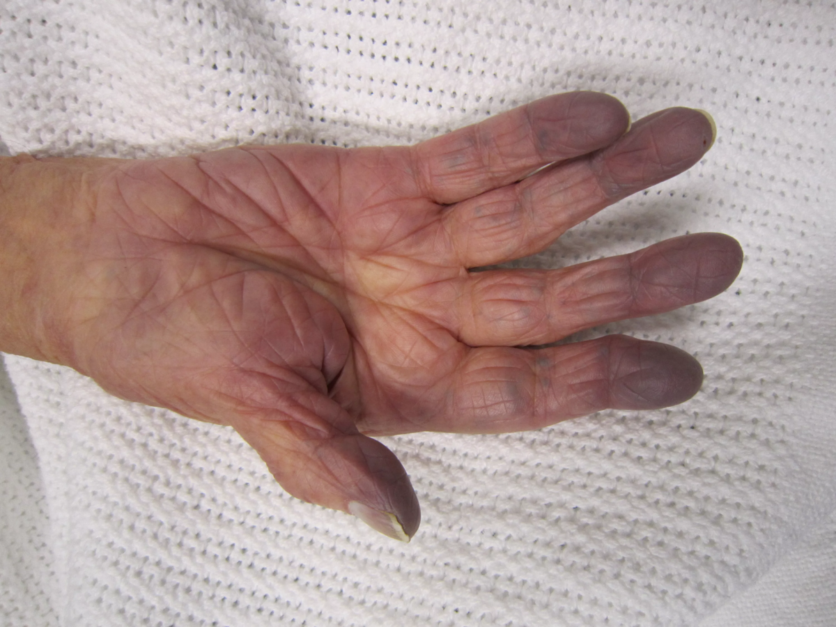 Почему пальцы темные. Акроцианоз синдром Рейно. Цианоз акроцианоз синдром. Цианотичность кожных покровов. Дистальный акроцианоз.