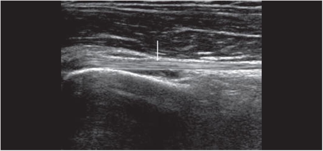 Рис. 1.	Фибриллярный, однородный, эхоплотный аспект сухожилия длинной головки бицепса плечевой кости (стрелка): продольное сканирование